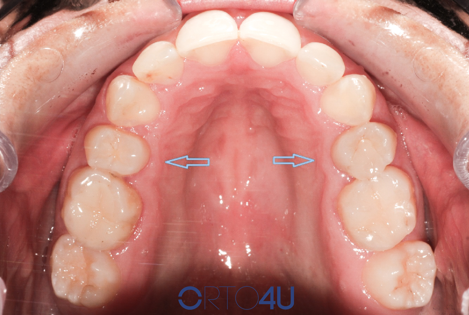 pomeranje zuba uz kost - ORTO4U