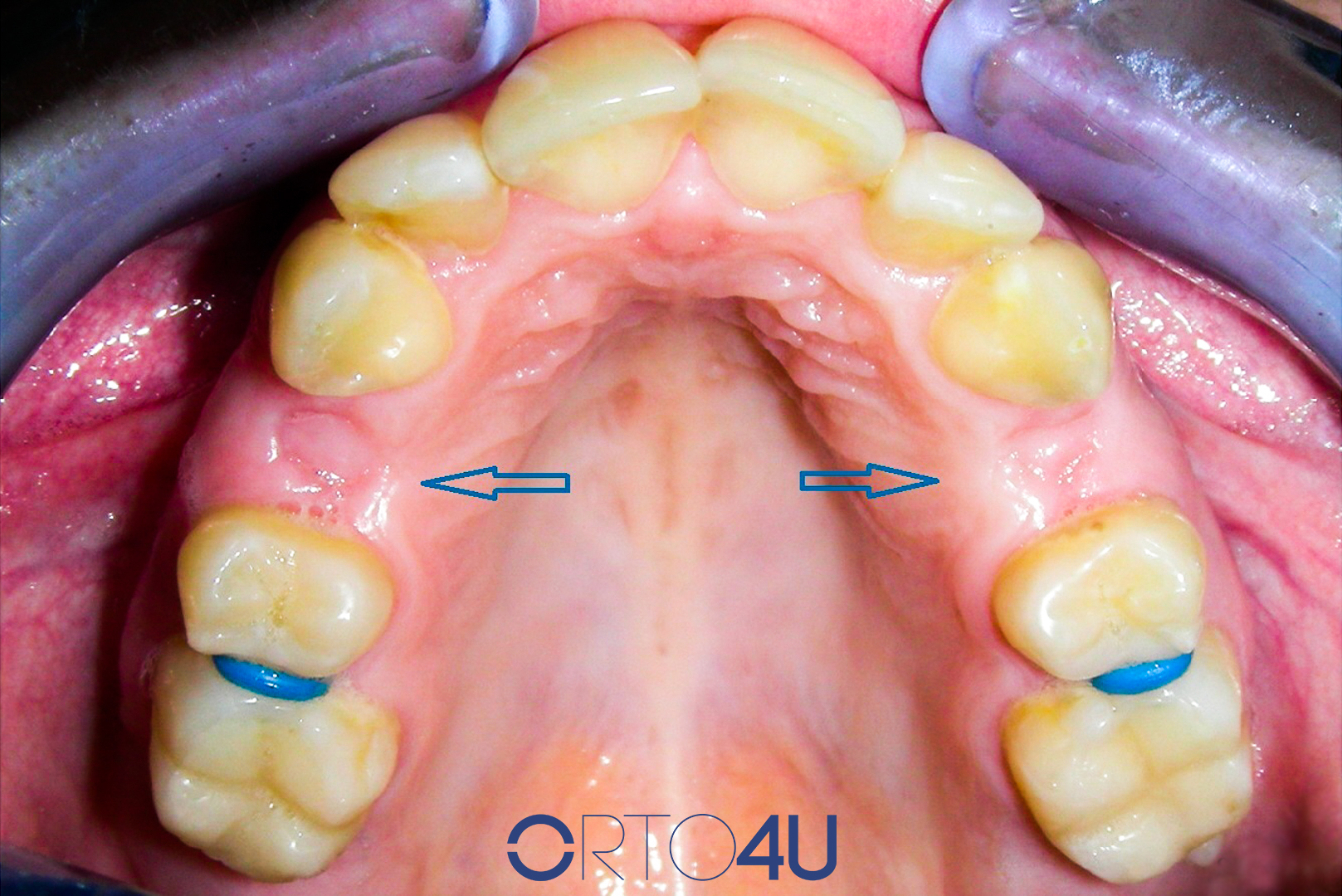 pomeranje zuba - ORTO4U
