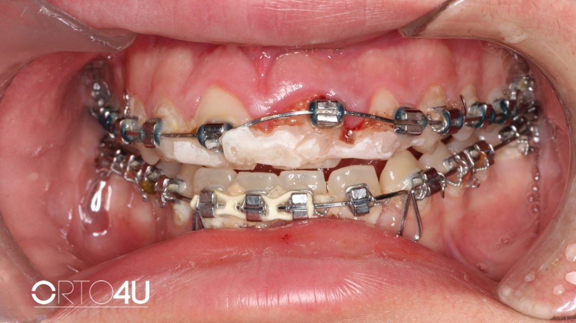 Orto4u izbijeni zub fiksna proteza