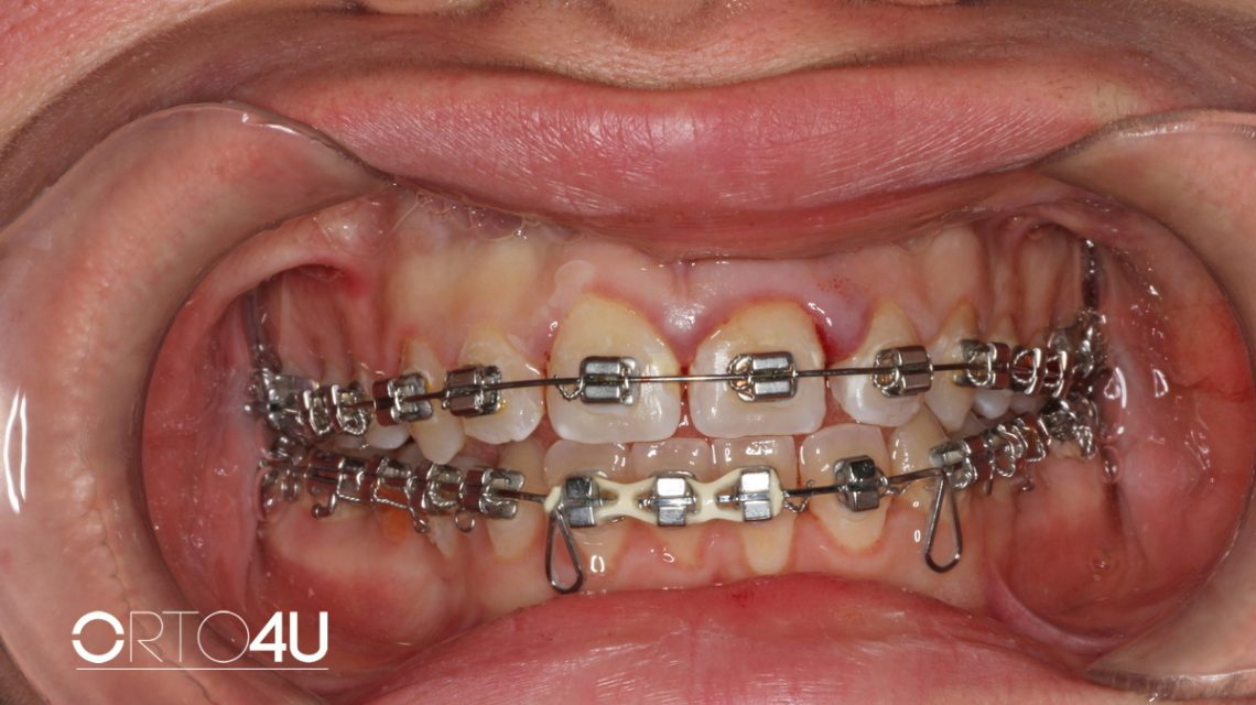 Izbijeni zub fiksna proteza
